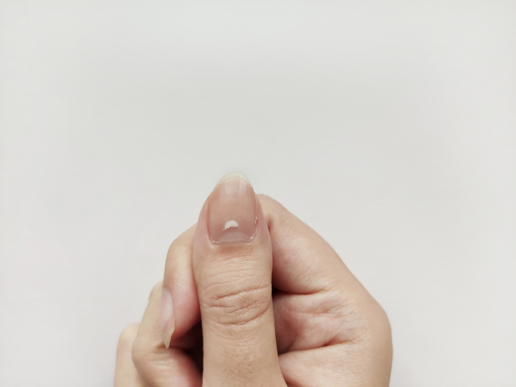 Как избавиться от белых пятен на ногтях: отвечают пользовательницы Woman.ru