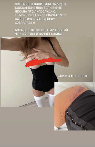 43-килограммовая блогер Ангелина Дубровская сделала липосакцию боков