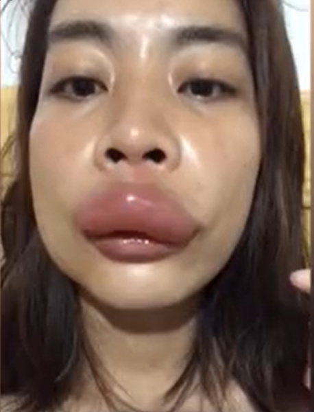 13 ужасающих фотографий людей с ужаленными губами