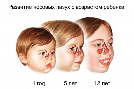 Как лечить гайморит у ребенка