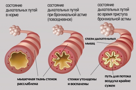 Бронхиальная астма у детей: симптомы