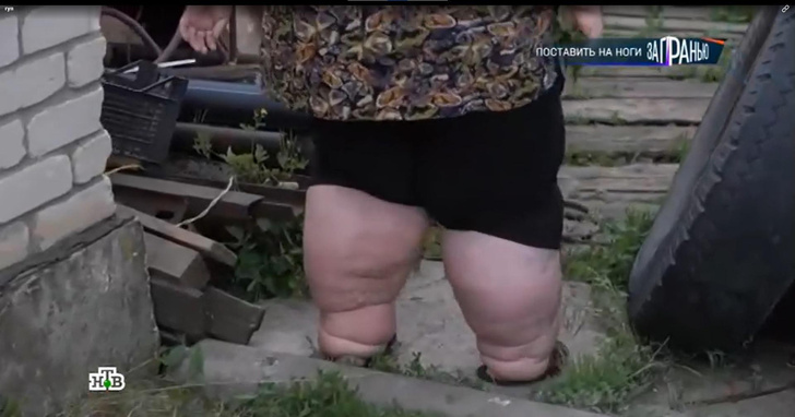 «Ноги сильно распухли и одышка»: 39-летнюю Кристину из Самары весом 178 кг спасают эксперты телешоу