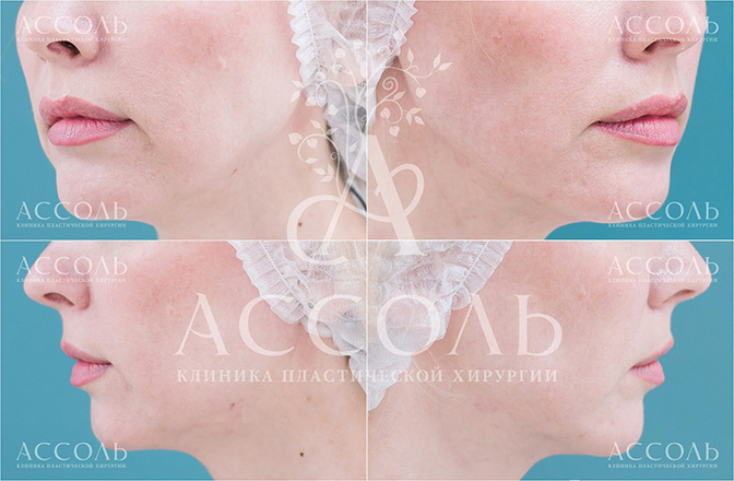 Лазерный липолиз фото до и после