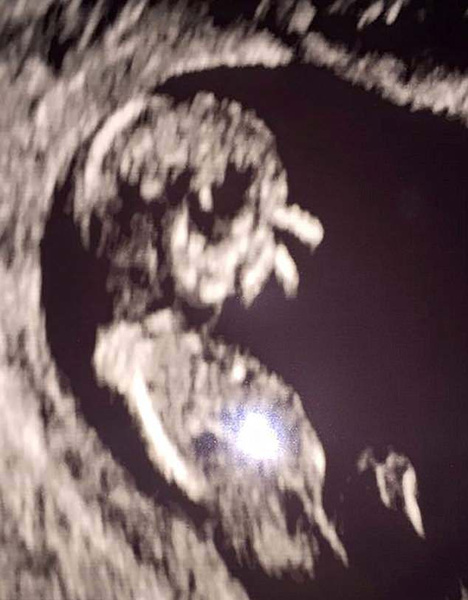 УЗИ и анализы при беременности УЗИ и анализы при беременности