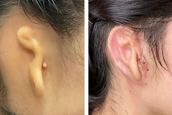 Напечатали за 10 минут: врачи впервые пересадили пациенту 3D-ухо