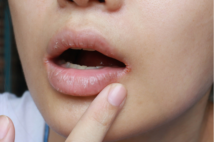 Трещины в уголках губ: что делать?