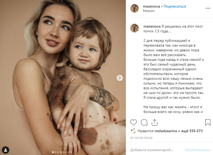 «Полтора года не решалась признаться»: блогер Катя Мезенова шокировала публику исповедью о редкой кожной болезни маленького сына