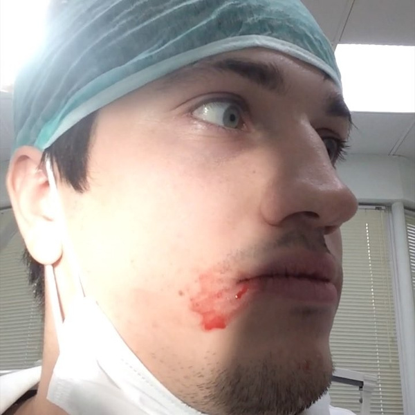 Врач из Сургута самостоятельно удалил себе зуб мудрости и снял это на видео