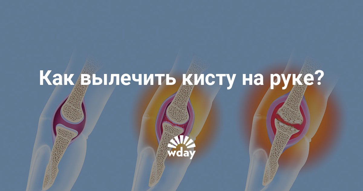 Киста на руке: как вылечить кисту, убрать кисту на руке | Журнал WDAY