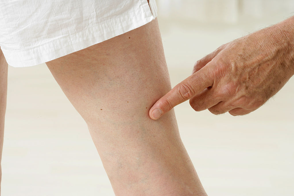 Este posibil să ungeți picioarele cu iod pentru varice?