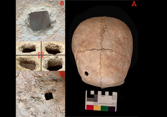 Радикальная медицина: зачем 4000 лет назад в Италии девушку похоронили с гвоздем в голове?