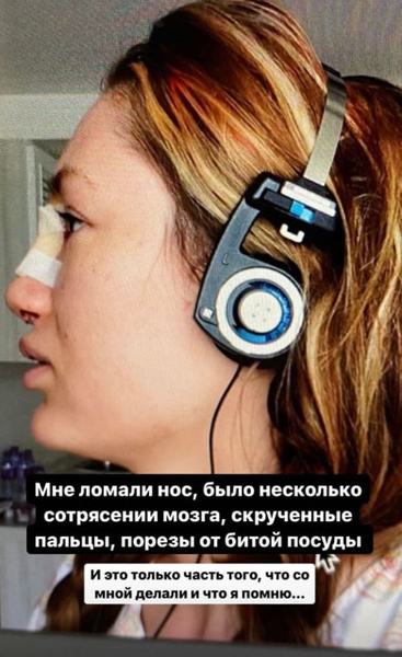 Сломанный нос, сотрясение мозга: Алена Ашмарина натерпелась от бывшего — фото