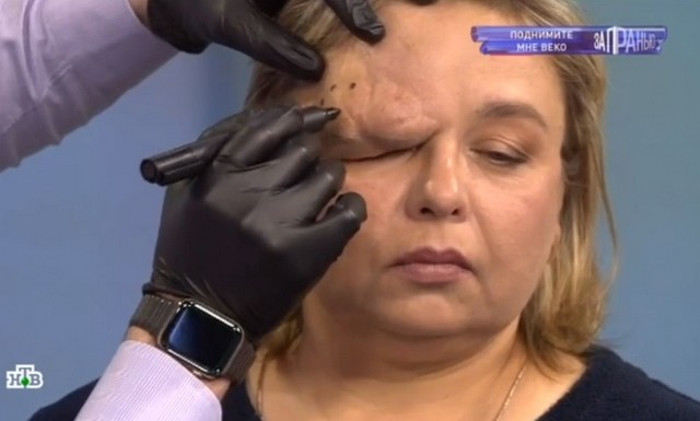 Женщина слепнет из-за огромной опухоли над глазом, которая разрослась на половину головы