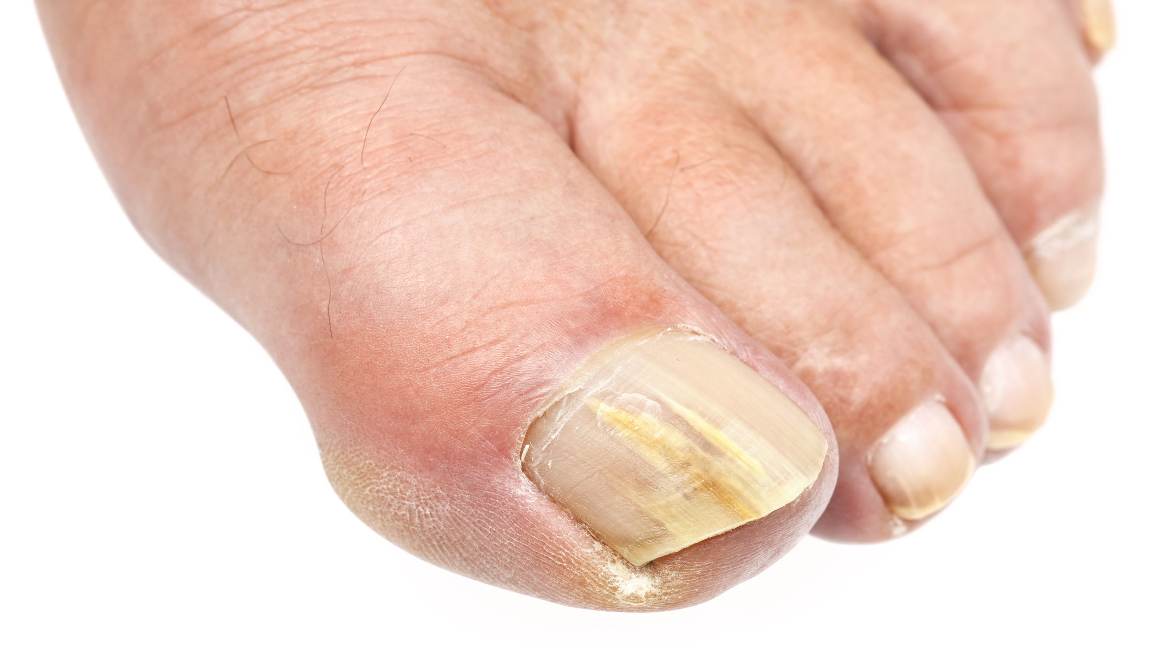 Желтые ногти - причины появления, симптомы заболевания, диагностика и способы лечения