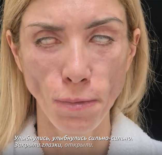 Не закрываются веки: победительница конкурса красоты требует от врачей 35 млн рублей за изуродованное лицо