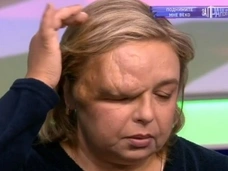 Женщина слепнет из-за огромной опухоли над глазом, которая разрослась на половину головы