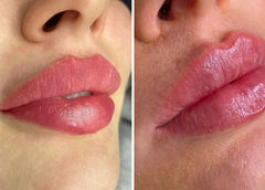 Результат поражает: 13 реальных фото женщин до и после увеличения губ