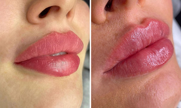 Результат поражает: 13 реальных фото женщин до и после увеличения губ