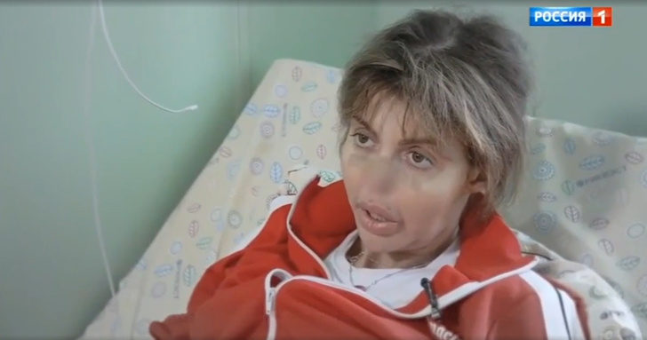 Алиса Аршавина: болезнь, без носа, как выглядит, пластика, симптомы, лечение