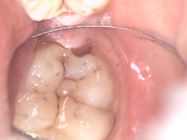 лечение зубов под микроскопом фото отзывы показания преимущества