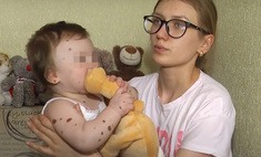 Загипсовали спину, не давали шевелиться: как живет девочка с родимым пятном после операции