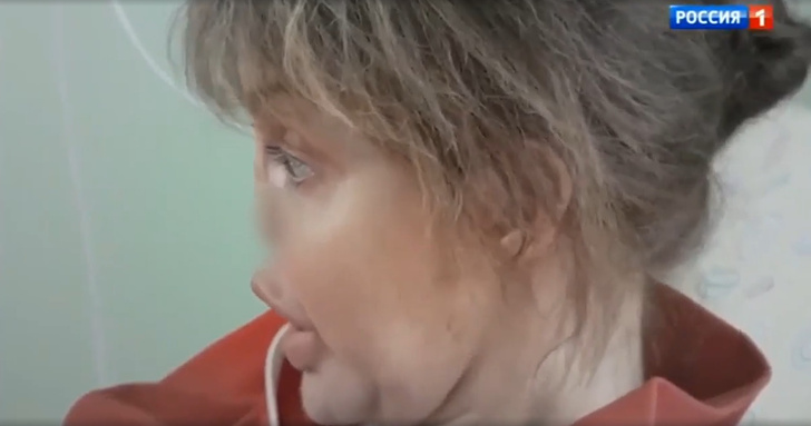 Алиса Аршавина: болезнь, как выглядит, что с носом, пластика, симптомы, лечение