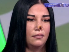Сожитель откусил матери троих детей нос во время драки: женщина может умереть из-за заражения